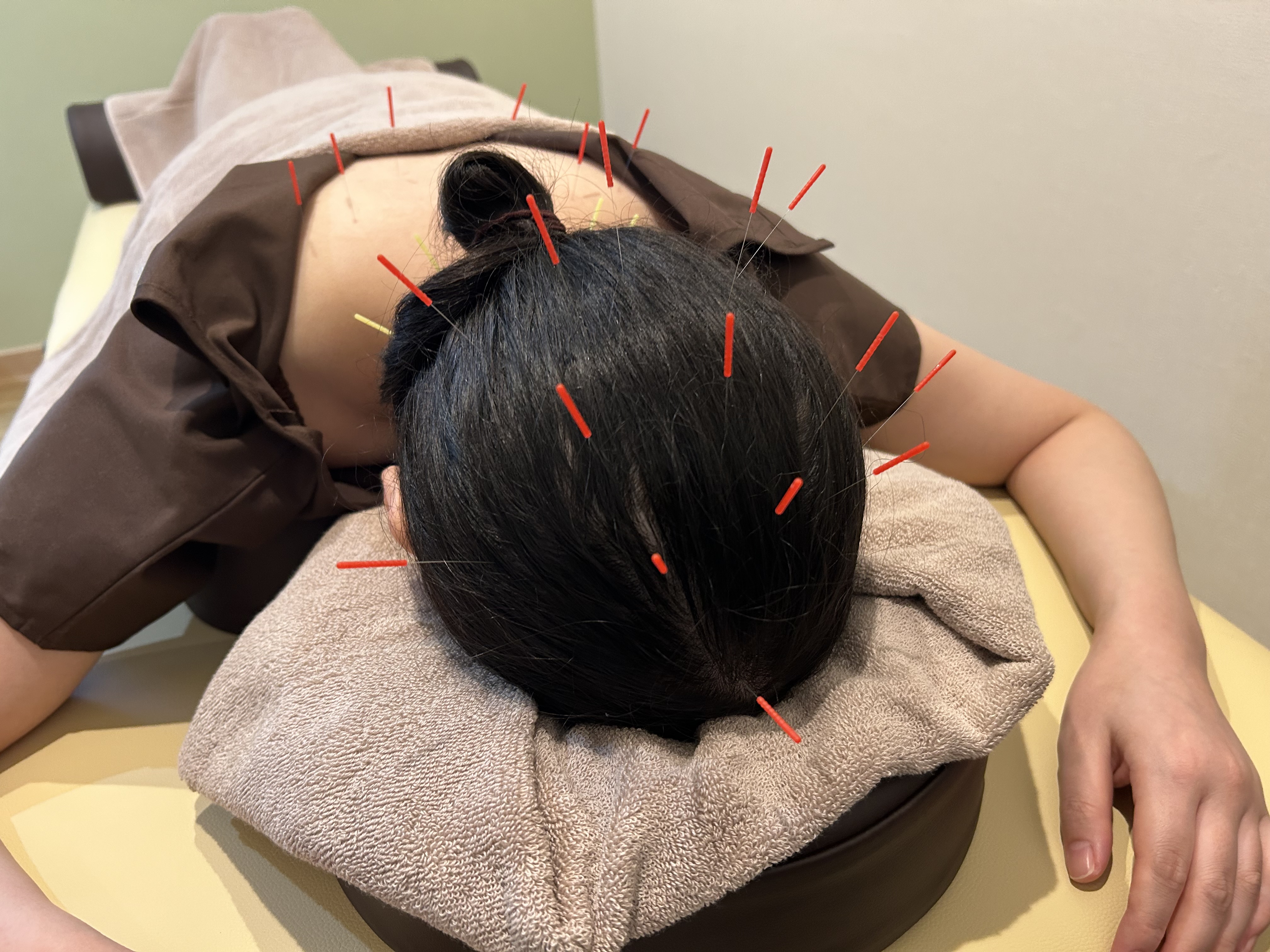 鍼灸の具体的な効果